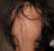 PRP para Alopecia areata. Inicio