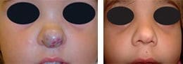 Hemangioma infantil