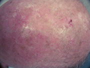 Queratosis actínicas