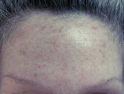 Queratosis actínicas